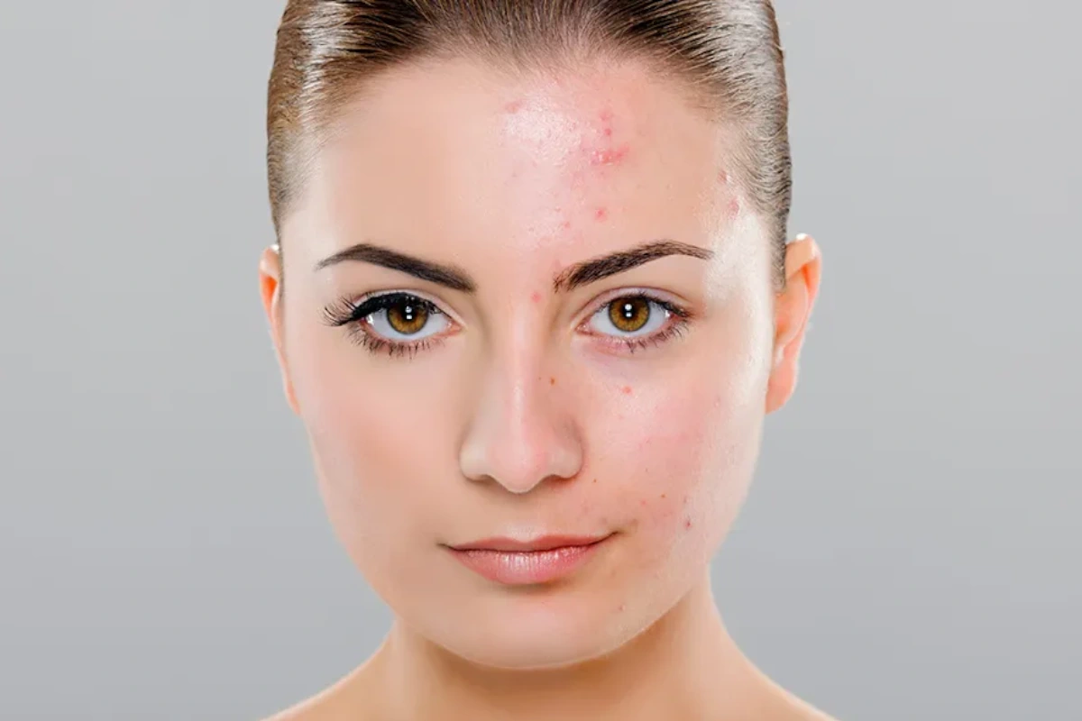 cicatriz acne